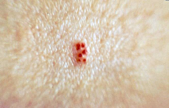 Signe « 2 » de l'Alliance sur le corps de Mimi, 1982